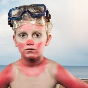 Sonnenbrand